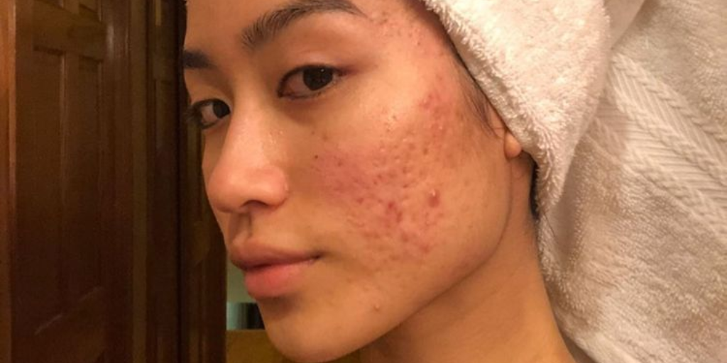 How to Treat Hormonal Acne and Stop Breakouts in Their Tracks