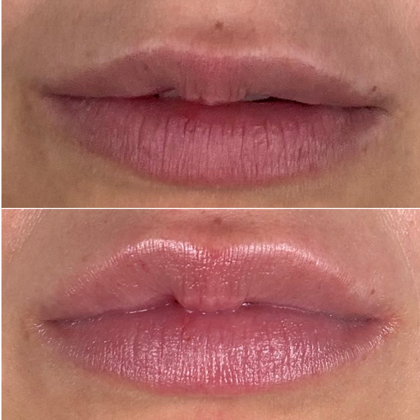 Before and after close-up comparison of a person's lips, showing a thinner dry lip on the top and a glossy fuller lip on the bottom.