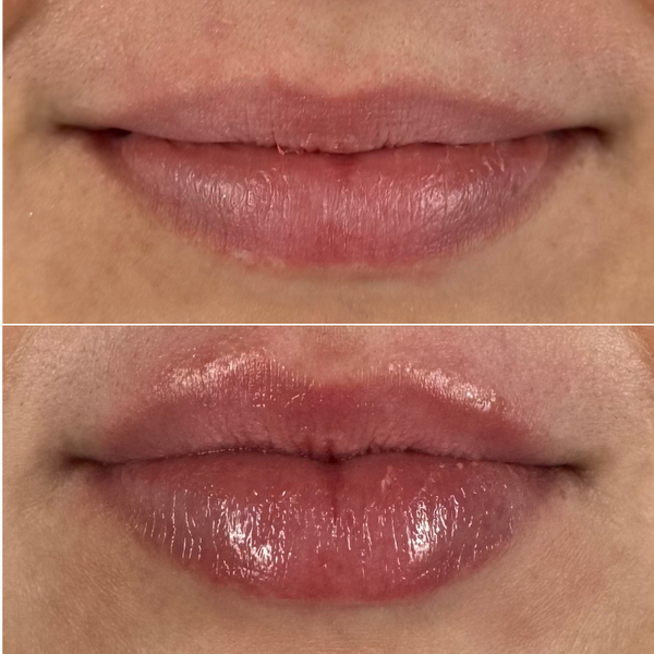 A close-up before-and-after style comparison of a person's lips. The top panel shows dry, thinner lips, and the bottom panel shows glowy, hydrated, fuller lips.