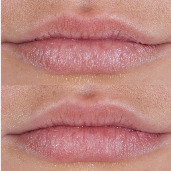 A close-up before-and-after comparison of a person's lips, showing dry, cracked lips in the top panel and smoother, hydrated lips in the bottom panel.