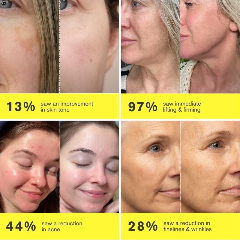 Before and after effects of ZIIP HALO shown on various skin concerns